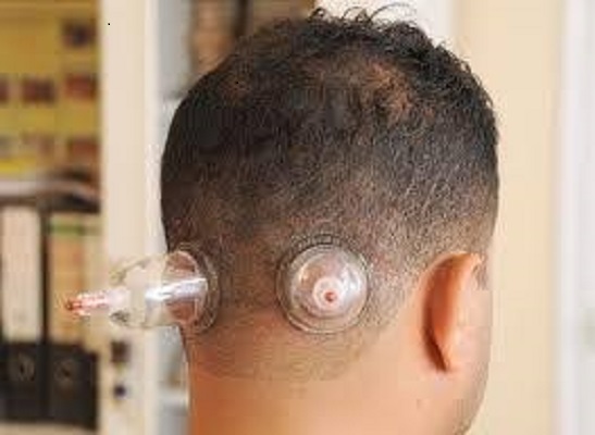 حجامة-لعلاج-الصداع-المزمن